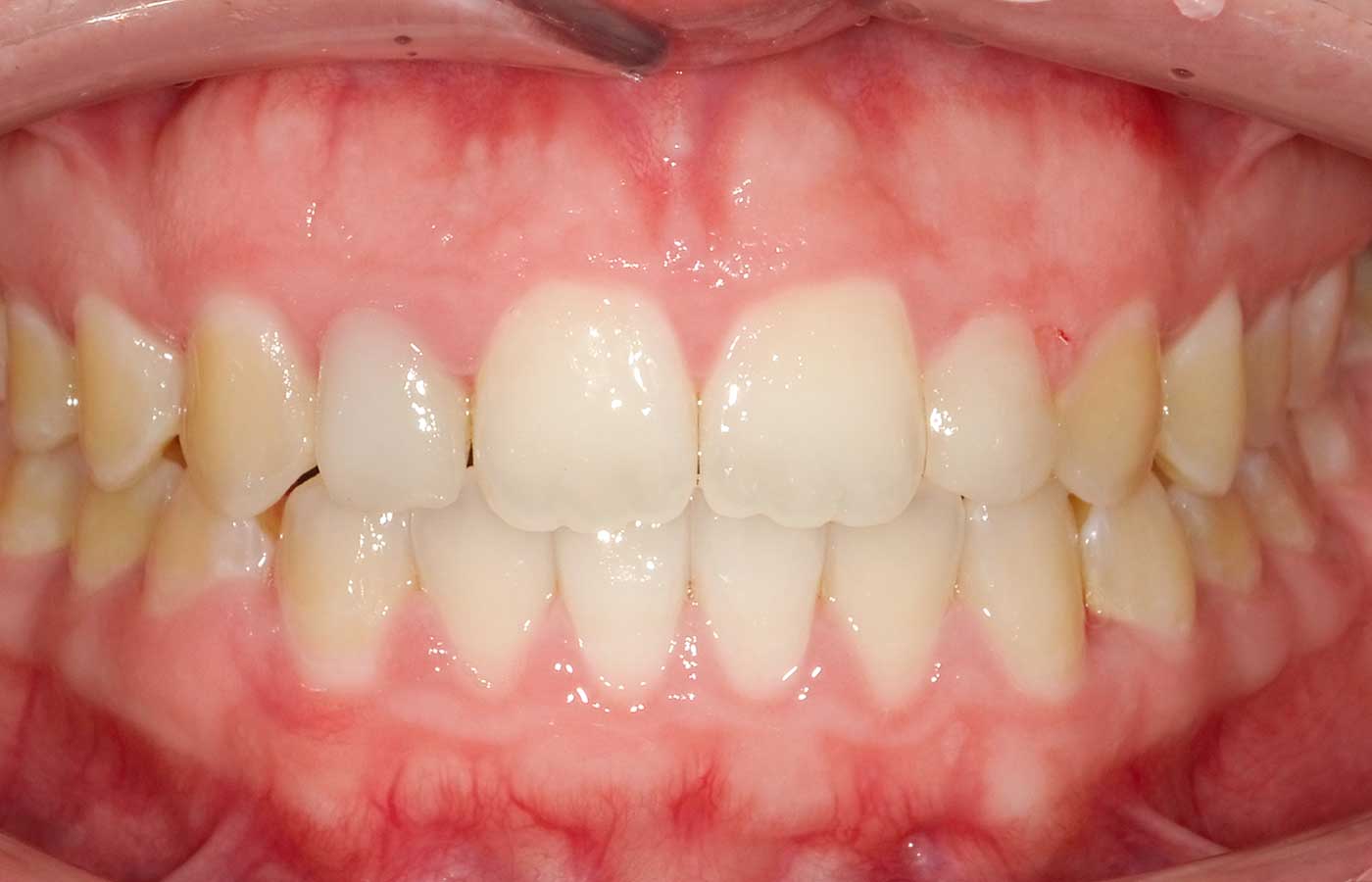 Trattamento ortodontico – Dopo